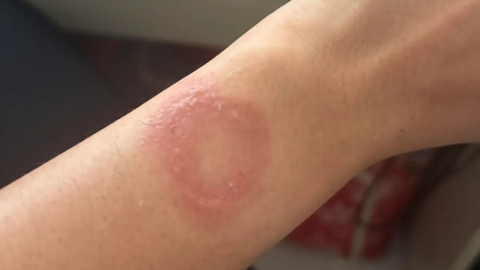 Apple Watch teria causado queimadura e usuário relata descaso da fabricante